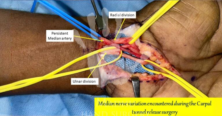 Carpal-tunnel-release-surgery