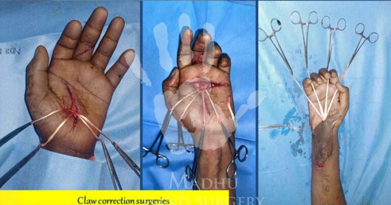 Claw-correction-surgeries