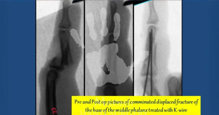 Comminuted-displaced-fracture