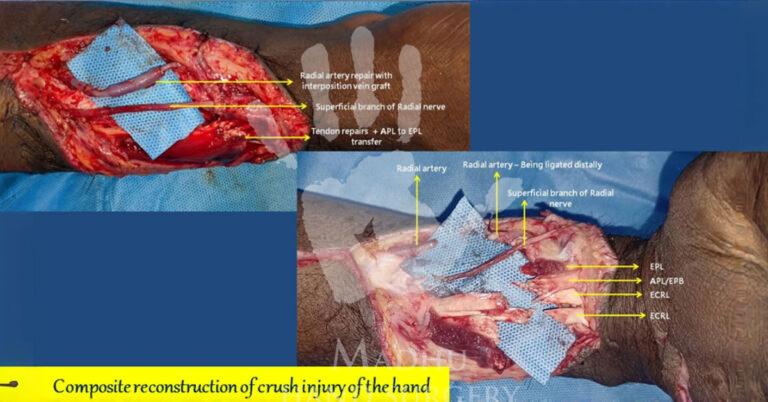 Composite-reconstruction