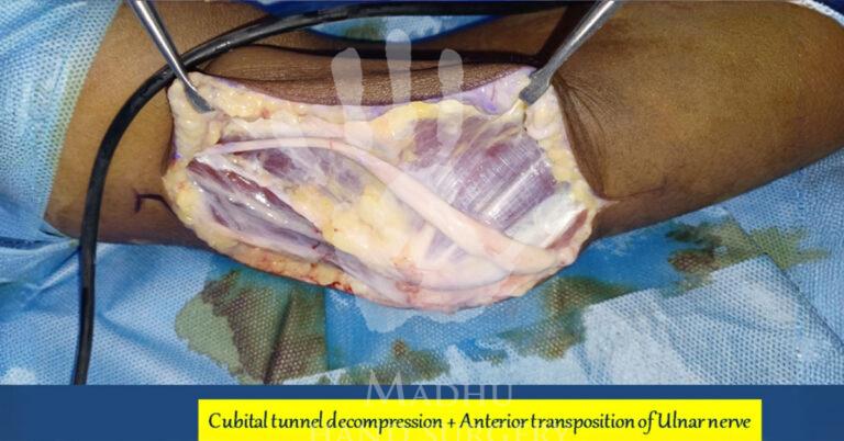 Cubital-tunnel-decompression