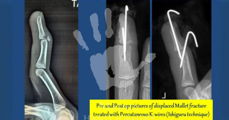 Displaced Mallet fracture