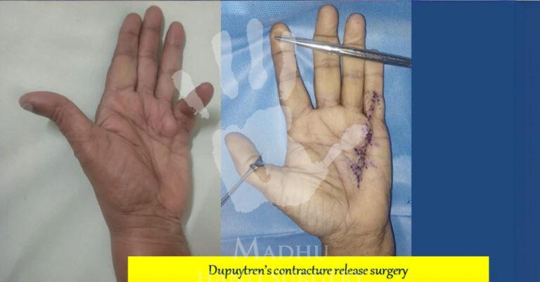 Dupuytren's-contracure-release-surgery