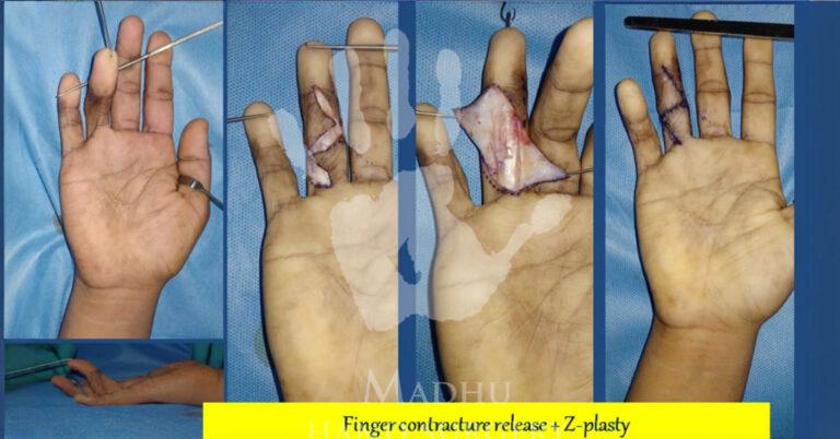 Finger-contracture-release