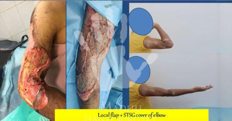 Local-flap-&-STSG-cover-of-elbow