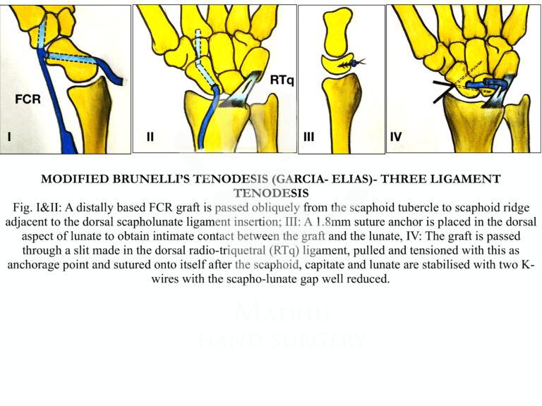 Modified-Brunellis'-tenodesis-technique