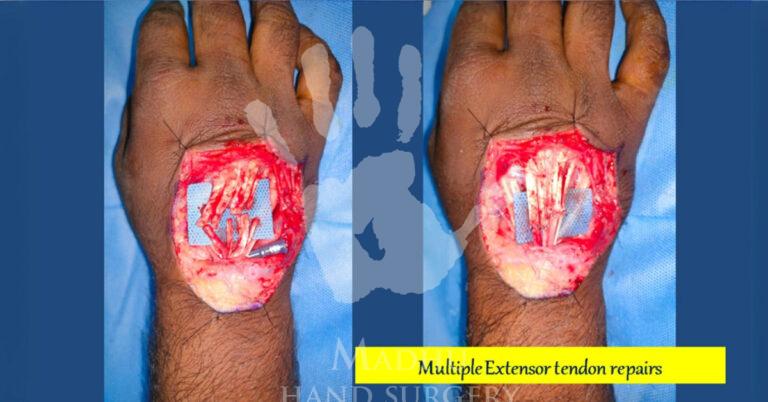 Multiple extensor tendon repair