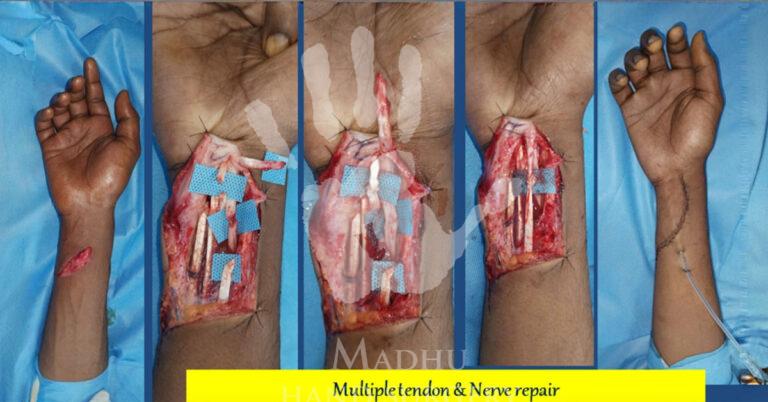 Multiple-tendon-&-nerve-repair