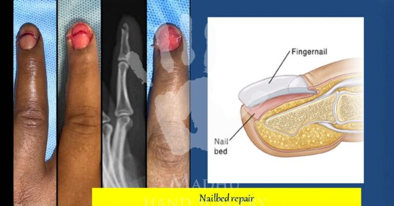 Nailbed-repair