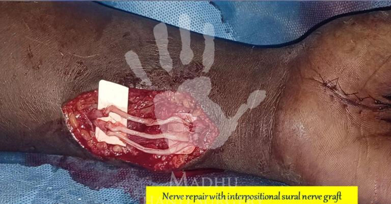 Nerve-repair