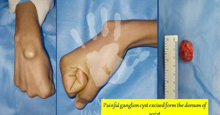 Painful-Ganglion-cyst
