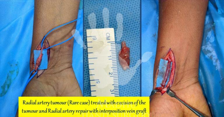 Radial-artery-tumor