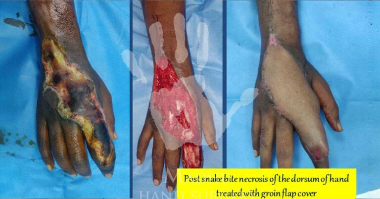 Necrosis of the dorsum of the hand