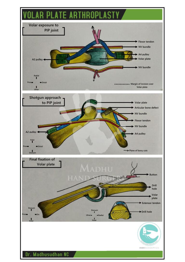 Volar-Plate-Arthroplasty