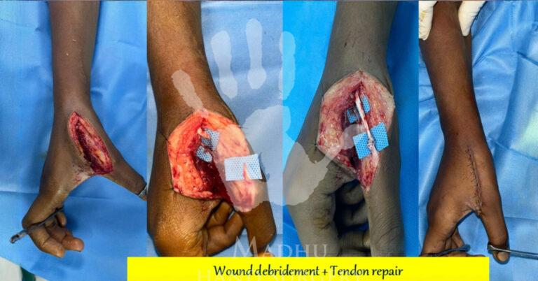 Wound-debridement-&-Tendon-repair