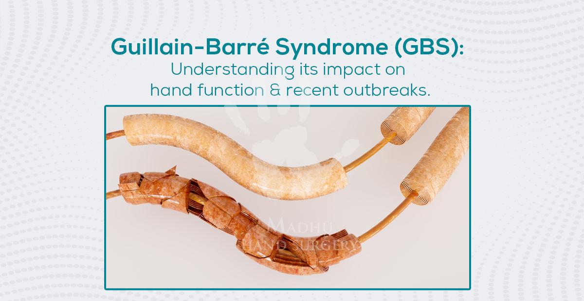 Guillain Barré Syndrome (GBS)
