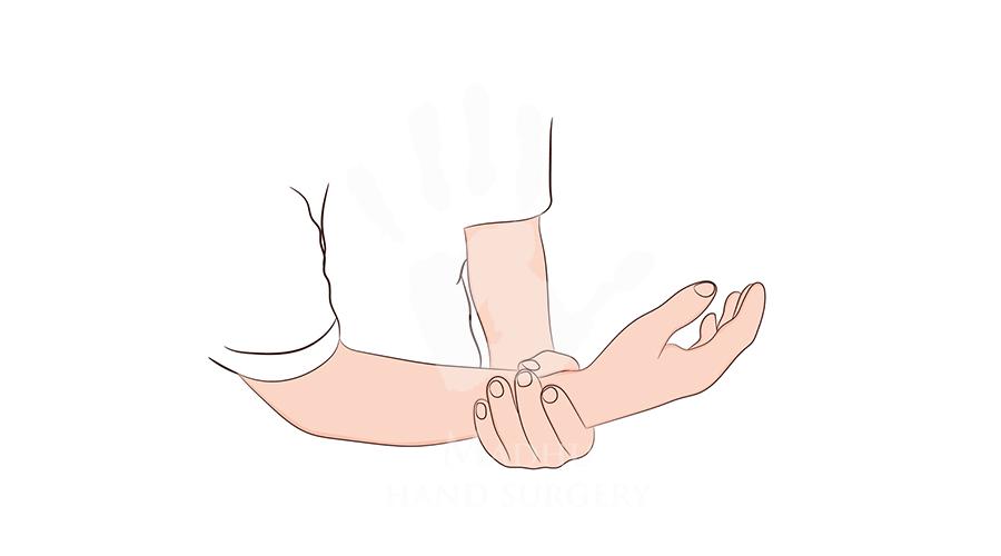 Hand with Guillain Barré Syndrome