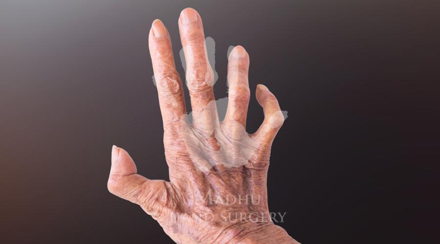 Leprosy hand