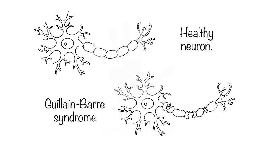 Syndrome