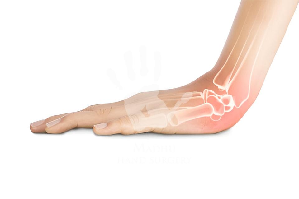 wrist fractures