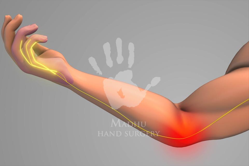 Cubital Tunnel Syndrome