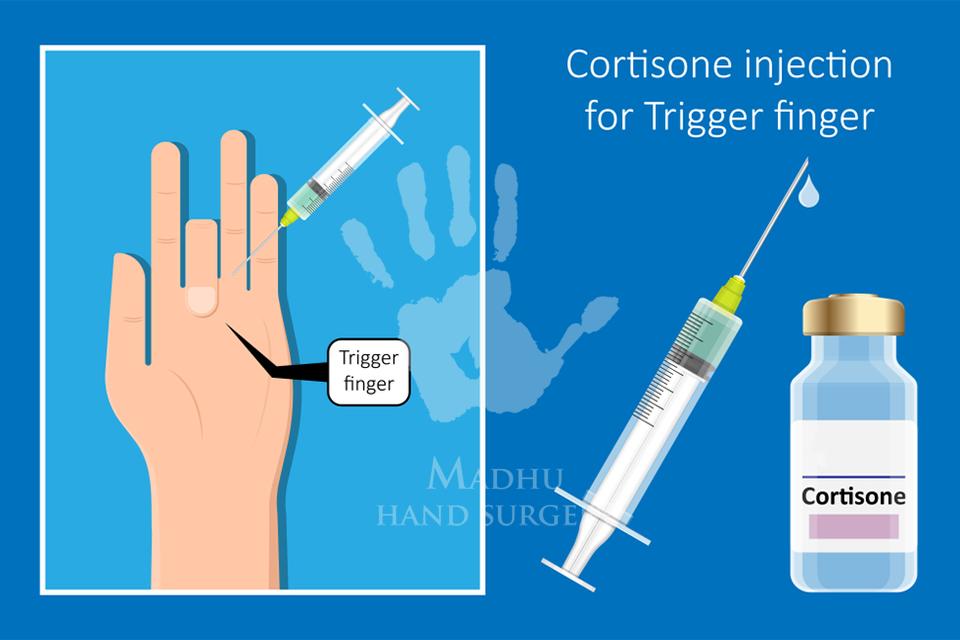 Cortisone Injection for Trigger Finger