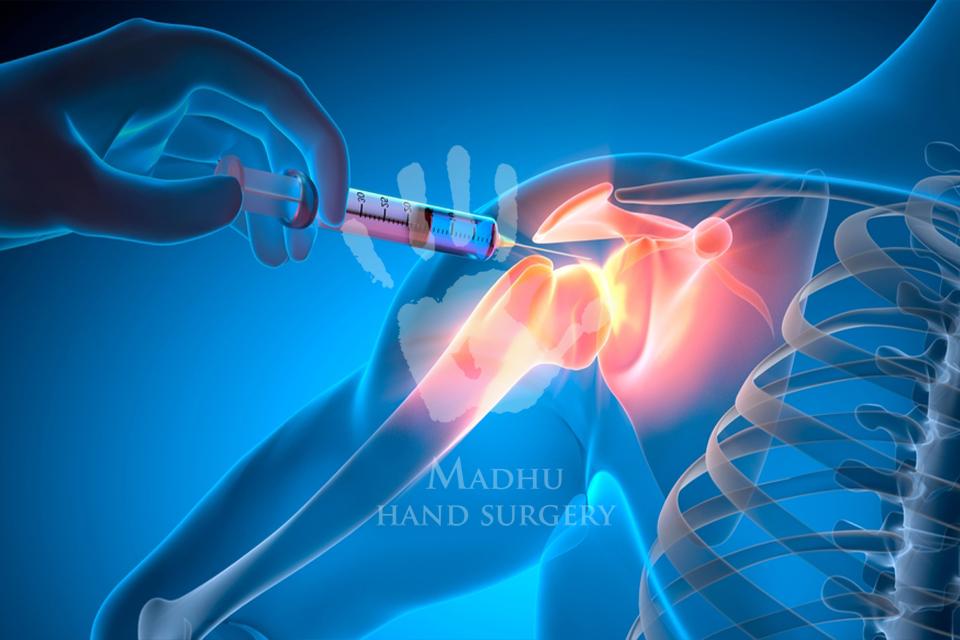 Cortisone Injection on joints