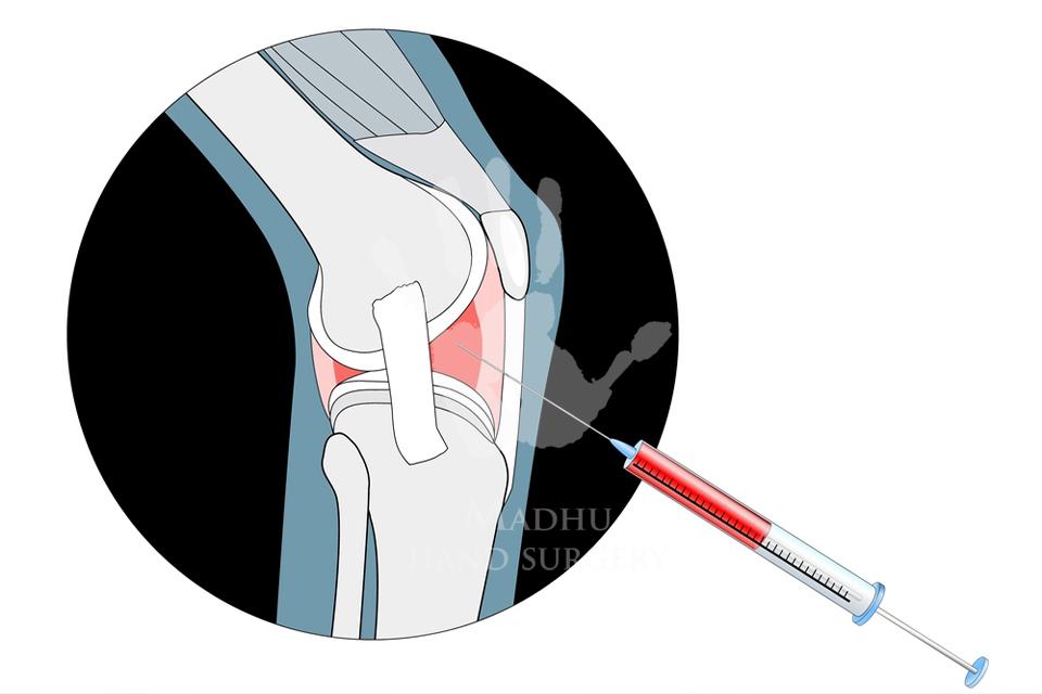 Cortisone Injection on knees