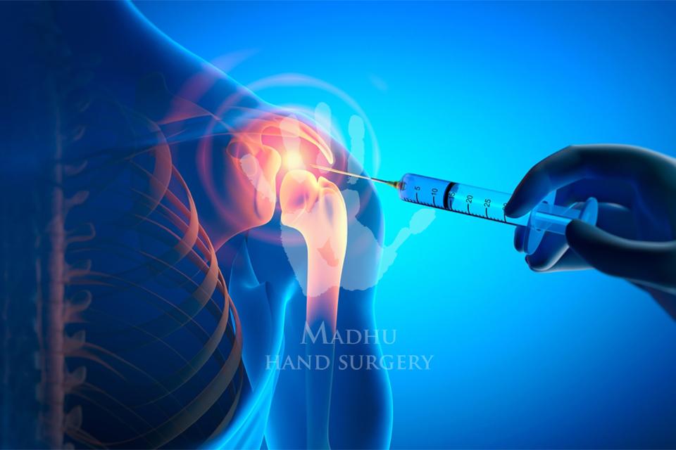 Cortisone Injection on shoulder
