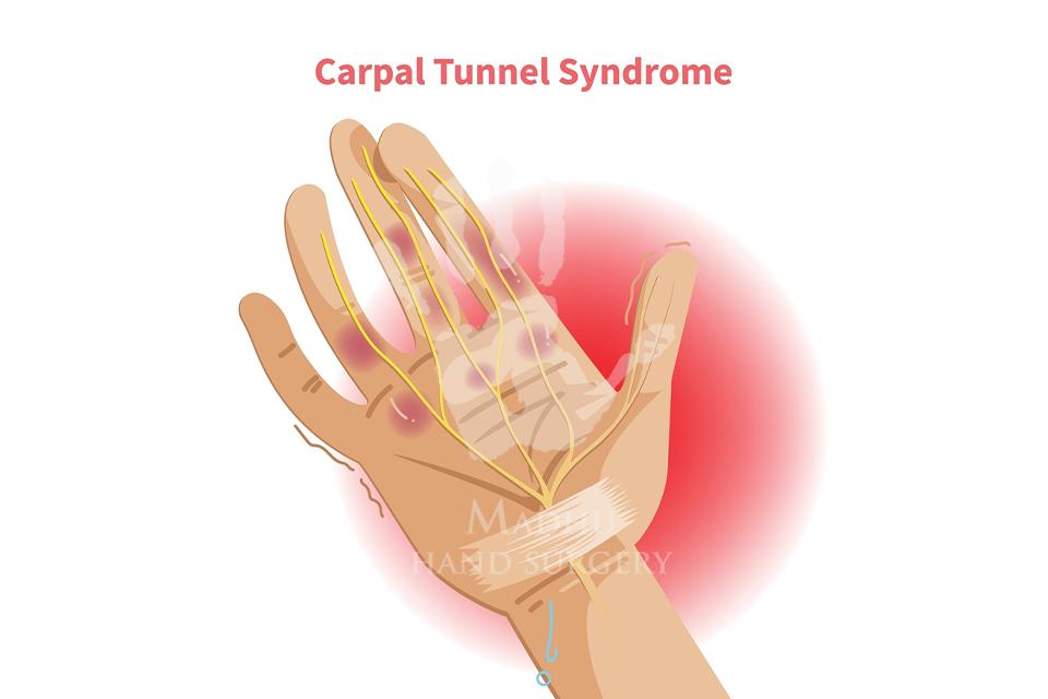 Carpal Tunnel Syndrome