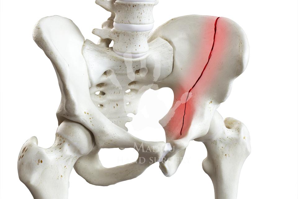 Hip Fracture