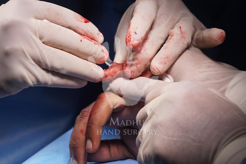Advanced Techniques Used in Hand Surgery