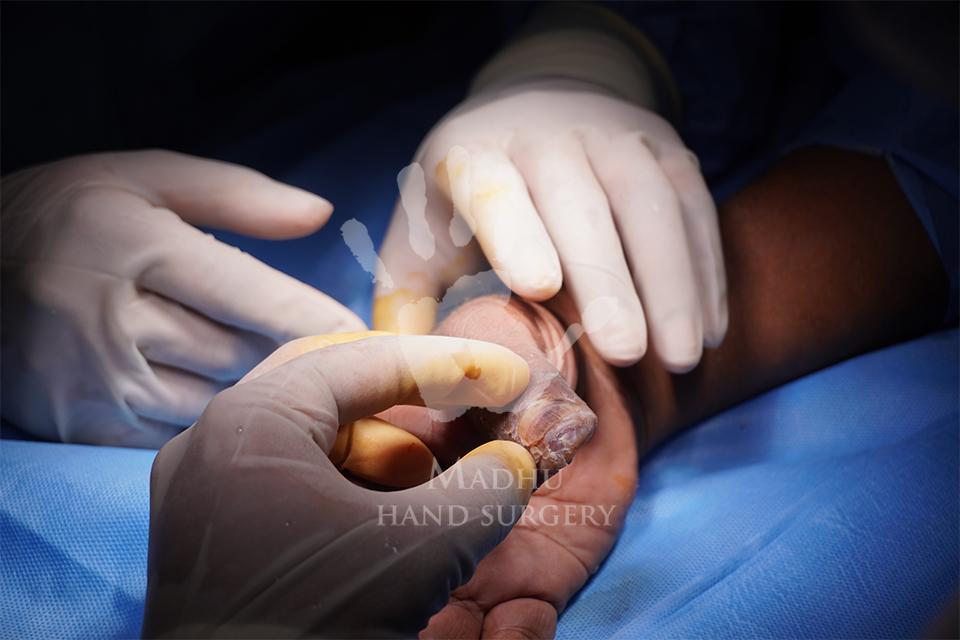 Hand surgery treatment