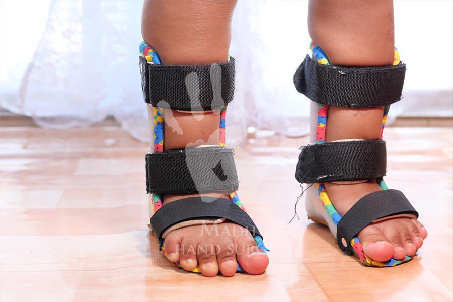 Bracing for Kids toe