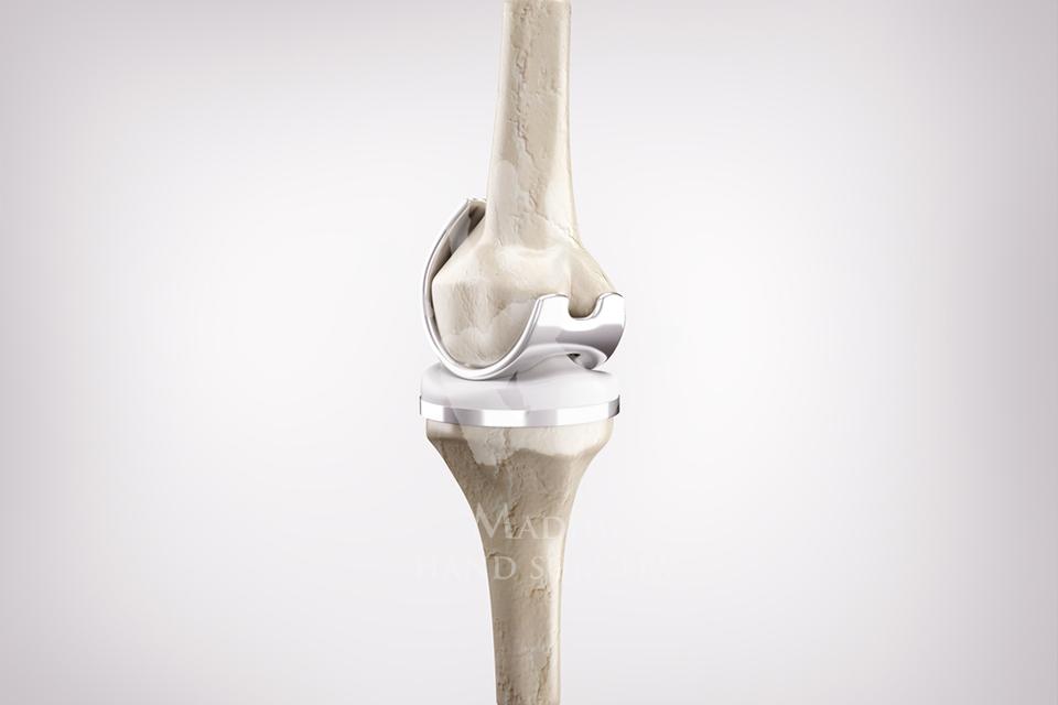 Knee Socket