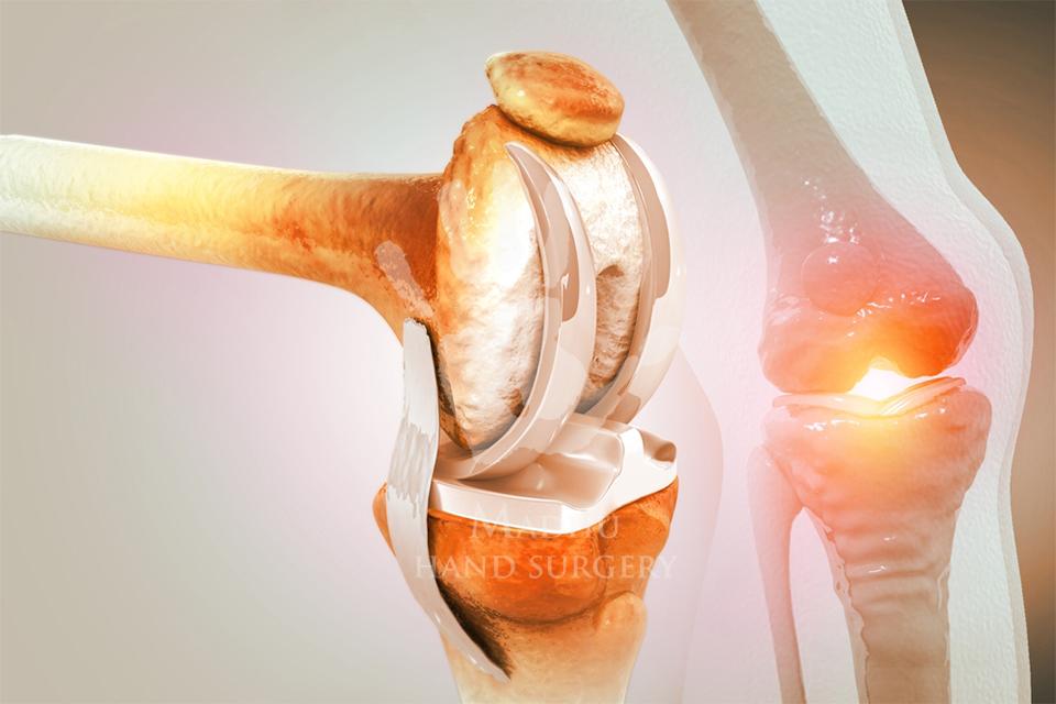 Knee surgery
