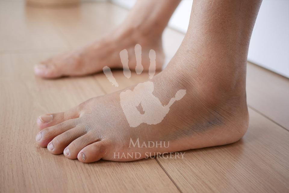Rigid Flat Feet