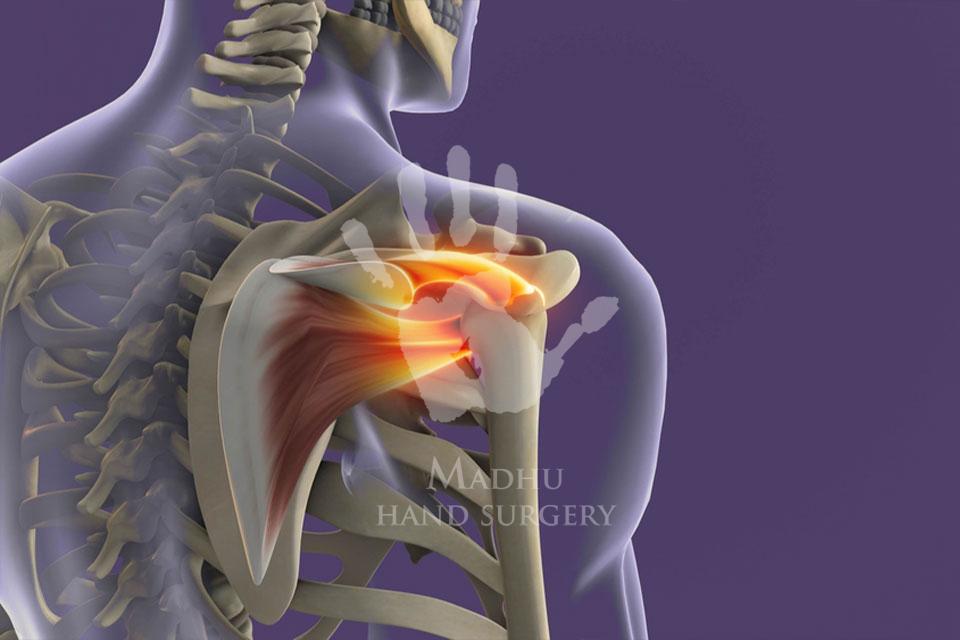 Brachial Plexus Surgery