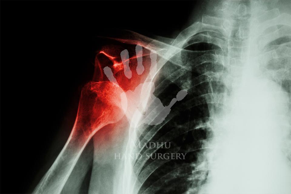 Dislocation of bones