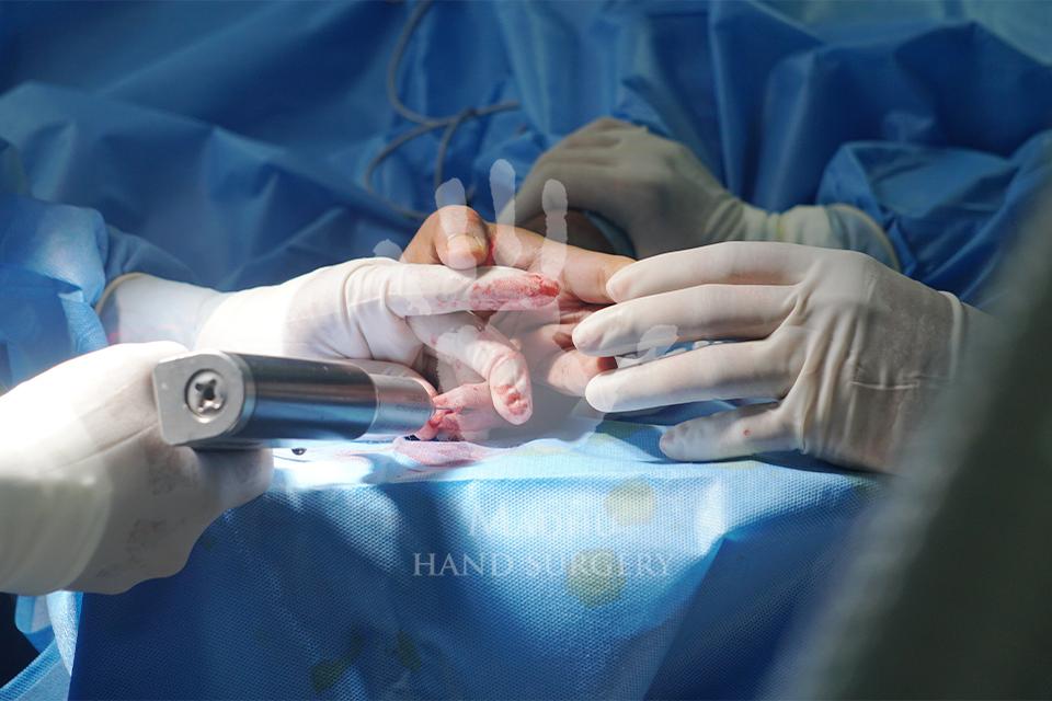 Hand surgery