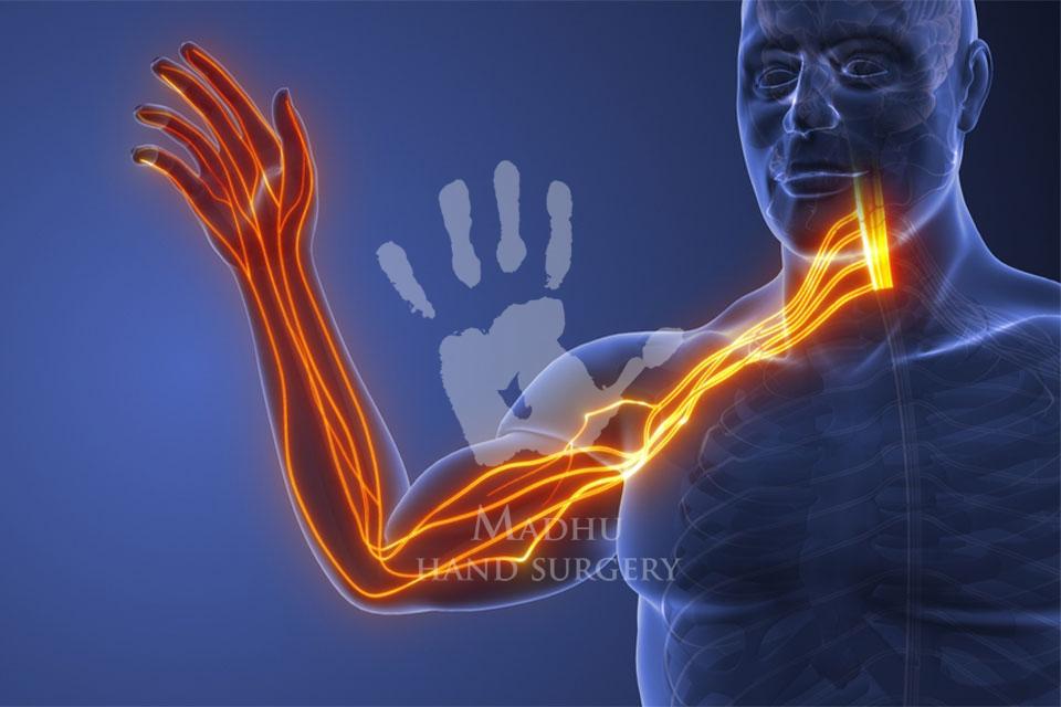 Nerve Transfer