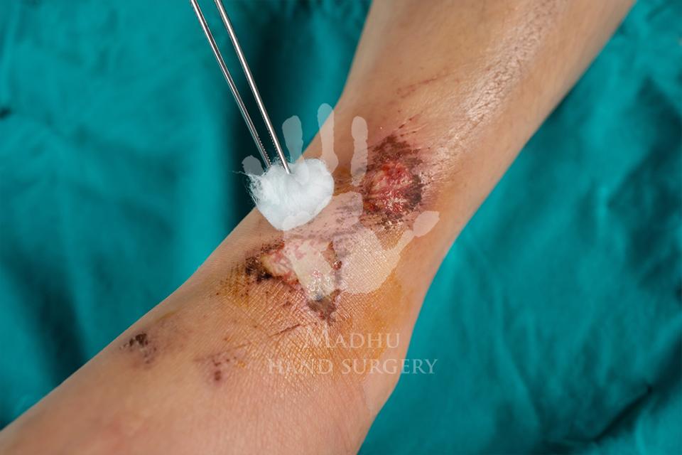 Wound Fracture