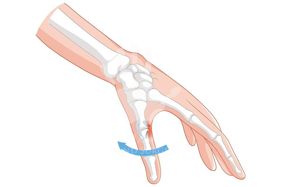 Finger Fracture