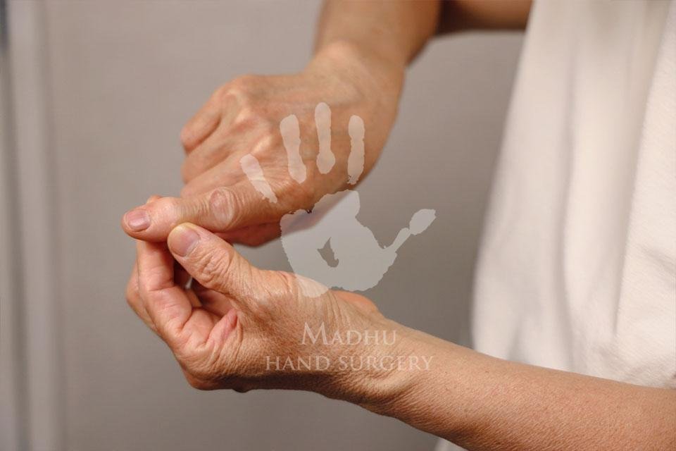 Finger deformity