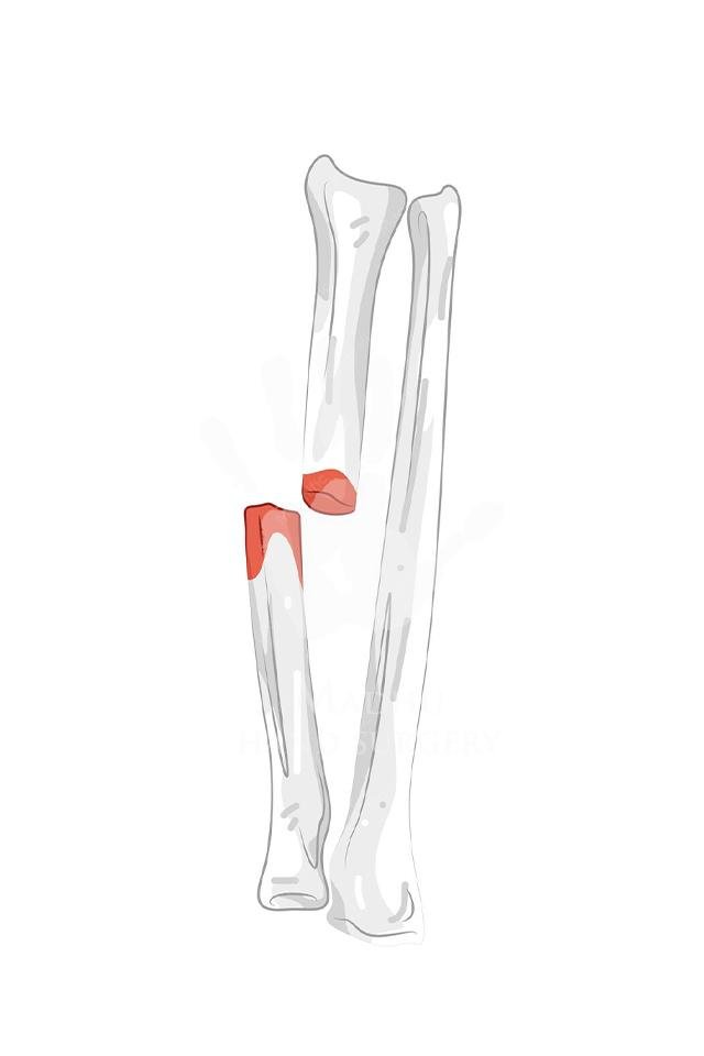Leg Fracture