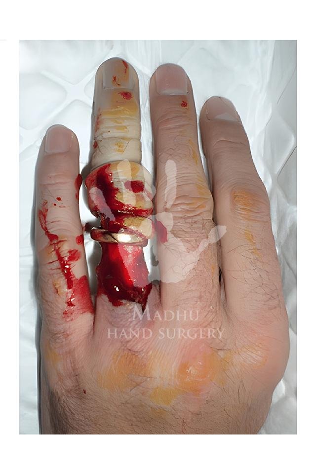 Ring on fractured finger