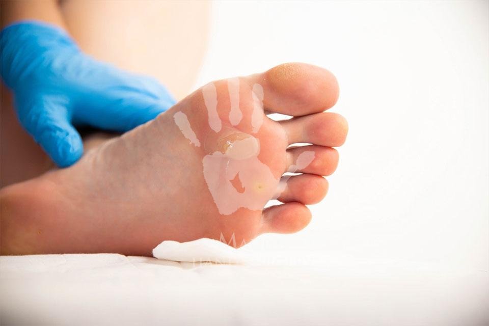 foot corns