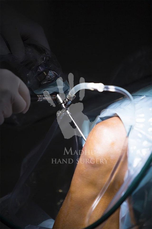 Arthroscopic
